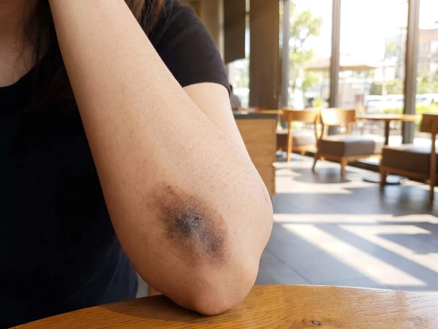 Close-up of a dark, dry patch of skin on a bent elbow resting on a wooden cafe table